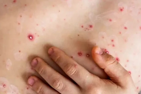Confirman posible primer caso de Mpox en Nayarit; joven abandonó hospital sin cumplir cuarentena