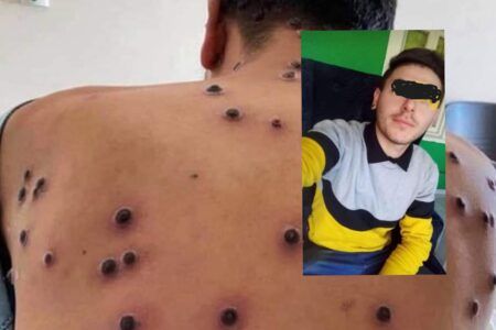 Fallece joven argentino por complicaciones de viruela símica