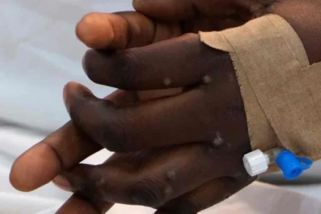 México registra 84 casos de mpox en 2024, según la Secretaría de Salud