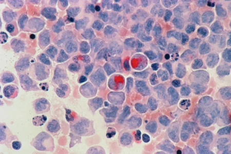 Huellas moleculares únicas permiten detectar cáncer en etapas tempranas con alta precisión